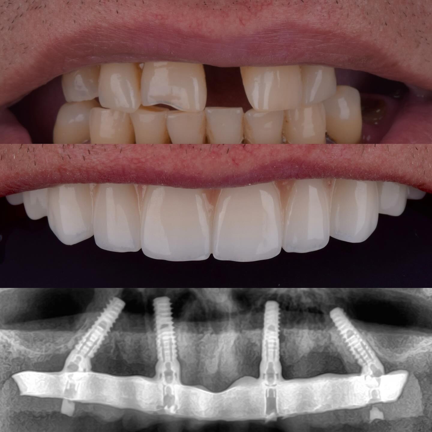 implanturi dentare si coarana de zirconiu